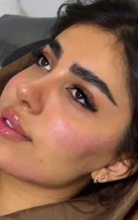 تزریق ژل لب M فیلر بادی بوتاکس آنزیم زاویه هیپ دیپ