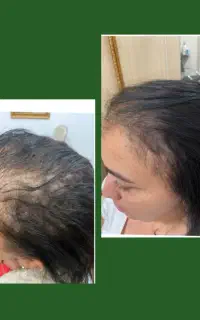 مو هات هنوز شانس برگشت داره