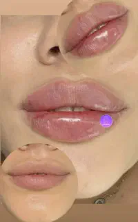 جشنواره تخفیف آموزش تزریقات ژل/بوتاکس/ فیلر بادی