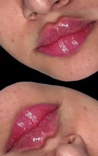 تزریق ژل و بوتاکس بامید فیس معروف