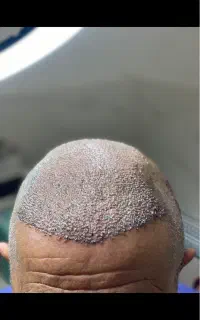 کاشت مو