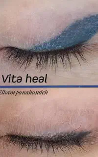 خدمات ریمو خط چشم فقط هزینه مواد
