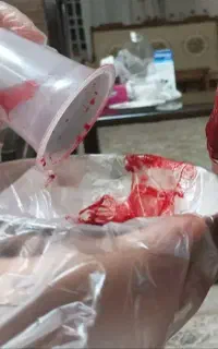 حجامت و زالو درمانی