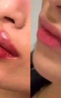 تخفیفات ویژه بوتاکس . ژل