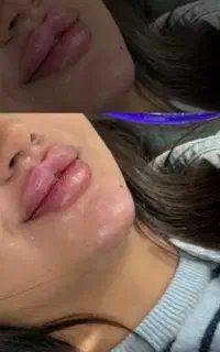 تزریق ژل و بوتاکس