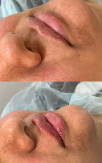 انجام خدمات فیلر و بوتاکس