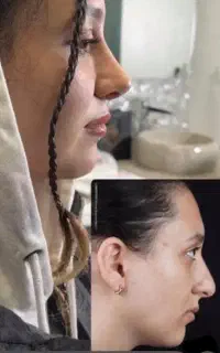 عمل بینی ساکشن کاشت مو غبغب ژل بوتاکس