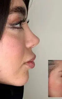 جراحی بینی در تهران ویژه مراجعین پلدختر/۴۳میلیون
