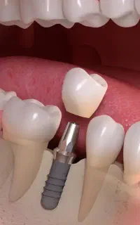 طرح طلایی ایمپلنت کره ای 14/700