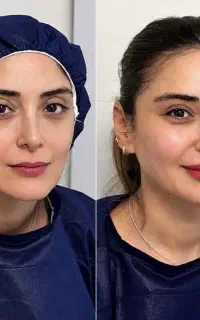 مدل تزریق چربی و نانوفت/ هزینه مصرفی/تعداد محدود