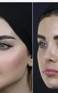 فیلرمزو بوتاکسprpژل اگزوزومprf بادی زیر مایو