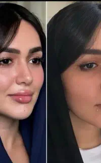 جشنواره تخفیفی ژل و بوتاکس/شرایط ازدم قسط