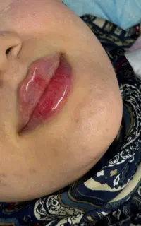 تزریق فیلر وبوتاکس (پی آرپی )چربی درکیلینک