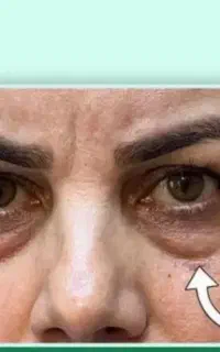بلفاروپلاستی دایرکت ابرو لیفت گونه لیفت شقیقه