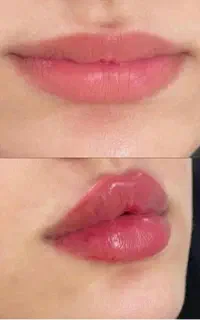 جشنواره فیلربادی ژل ،بوتاکس ،جوانساز پروفایلو