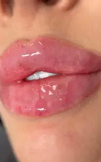 ژل بوتاکس لیزر تتو مزو خال زگیل تناسلی لک هیپ دیپ