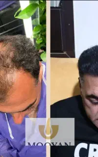 کاشت مو ۲۲ و کاشت ابرو ۱۵
