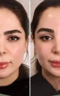 جراحی بلفاروپلاستی وجراحی های زیبایی و تزریقات