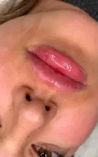 فیلر و بوتاکس