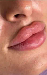تزریق بوتاکس ژل لب با جدید ترین تکنیک های روزد نیا
