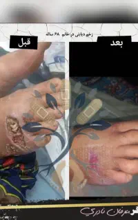 درمان تخصصی انواع زخم در منزل شما