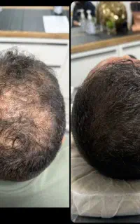 معجزه رویش مجدد موهات
