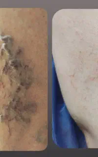 ‌کلینیک تخصصی درمان واریس