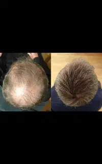 پرپشتی به خودت هدیه کن