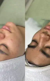 تخفیف پاکسازی با بهترین متریال دستگاه های بروزپوست