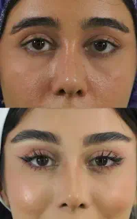 مرکز بلفاروپلاستی لیزری مشهد/لیفت شقیقه/غبغب/اقساط