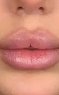 تزریق فیلر (ژل) و بوتاکس