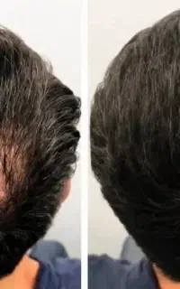 بررسی علت کم‌پشتی