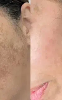 فیشال یا پاکسازی عمقی فقط399هر لک79تومان