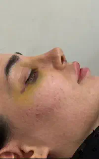 عمل زیبایی بینی و پلک/لیفت صورت با تعرفه ۱۴۰۴