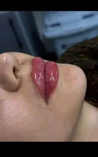 تزریق ژل لب ب مدت سه روز در انار با قیمت  دوتومن