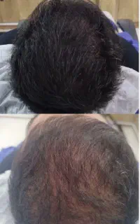 میکرواسکالپ تضمینی و تخصصی در کلینیک پوست ومو
