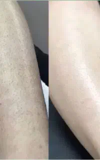لیزربدن فول بادی تضمینی(۵۵۰تومن)جلسه آخربدون هزینه