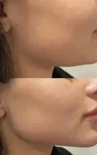 آموزش ژل بوتاکس نخ لیفت