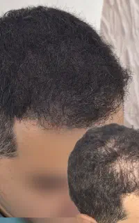 رفع کم پشتی مو / میکرواسکالپ