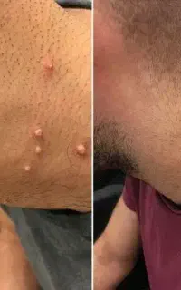 نابودی hpvزگیل ووتبخال