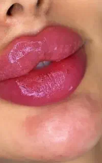 تخفیف ویژه ژل فیلر بوتاکس