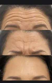 مدل بوتاکس