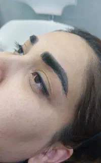 میکروبلیدینگ نانو اولین بار در شوشتر