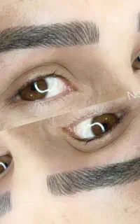 میکروبلیدینگ ، فیبروز ابرو