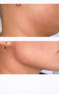 ساکشن و تزریق تمام نواحی . قیمت استثنایی توسط پزشک