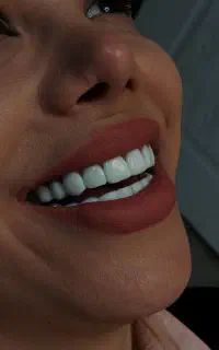 تخفیف ویژه کامپوزیت به مناسبت افتتاحیه کلینیک