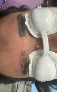 ریموو تاتو با دستگاه لیزر ۵۰۰