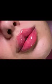 تزریق فیلر و بوتاکس فقط با هزینه مواد