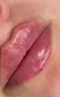 آموزش و خدمات تزریق ژل و بوتاکس تخفیف ویژه