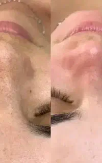 پاکسازی پوست با تخفیفات